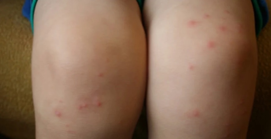 Аллергия на коже от укусов блох thumbnail