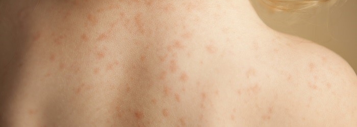 Аллергия на укусы блох у ребенка фото thumbnail