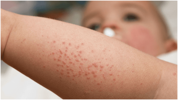 Аллергия на комариные укусы у ребенка фото лечение thumbnail
