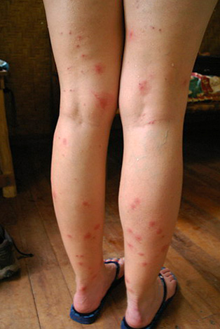 Аллергия на укус блохи лечение у человека thumbnail