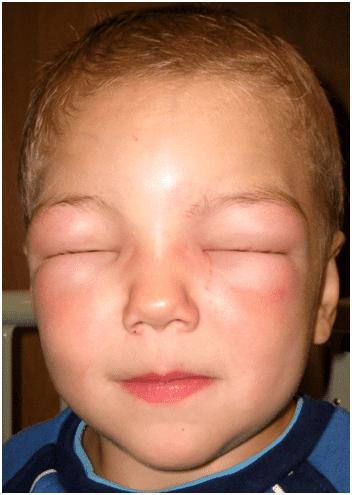 Сильная аллергия у ребенка на комариные укусы thumbnail