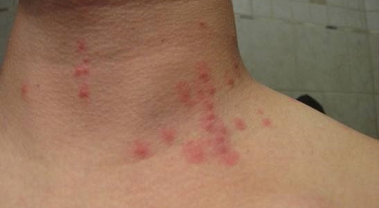 Аллергическая сыпь от укуса блох thumbnail