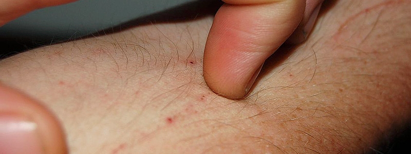 Аллергия на укусы блох фото thumbnail