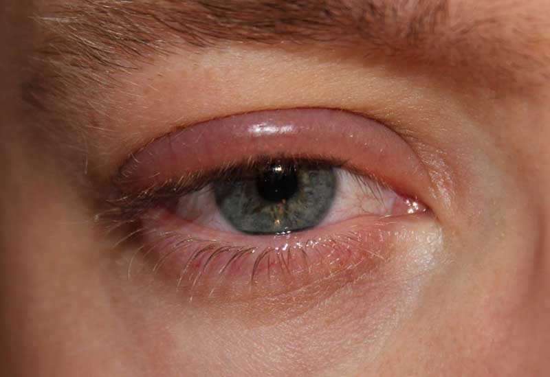 укус таракана на человеке в области глаз