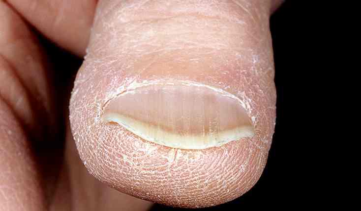 Анемия из-за клопов вызывает заболевание ногтей