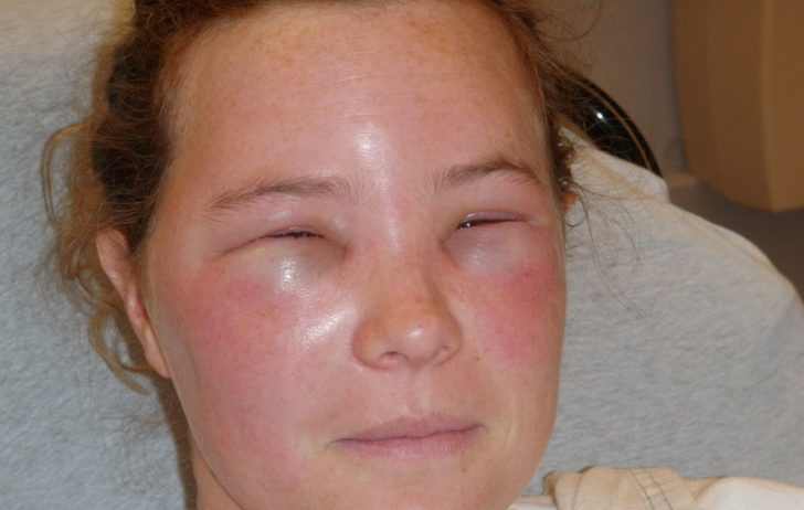 Системно-аллергические последствия укусов клопов на теле человека